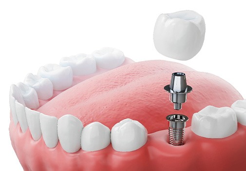 Rendering of implant and crown in lower arch with white background