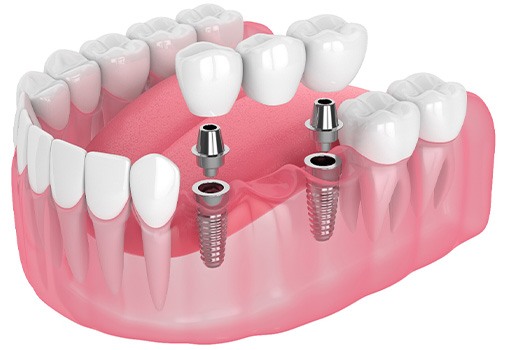 Rendering of implant bridge in lower arch with white background