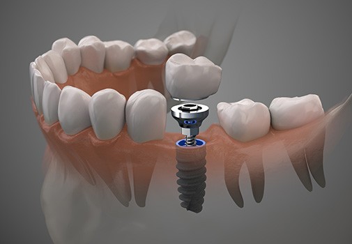 Rendering of dental implant abutment and crown in lower jaw with gray background