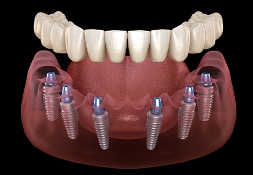 Rendering of implant dentures for lower arch with black background