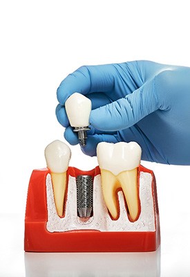 A dental implant model near Winchester