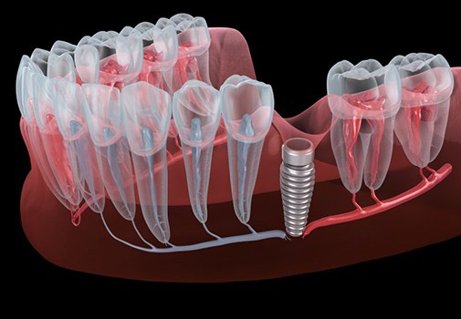 Illustration of dental implant in gum tissue