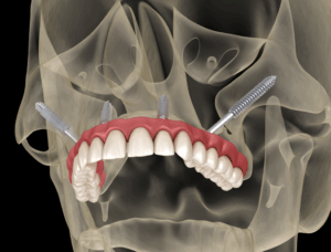 a 3D illustration showing how zygomatic dental implants work