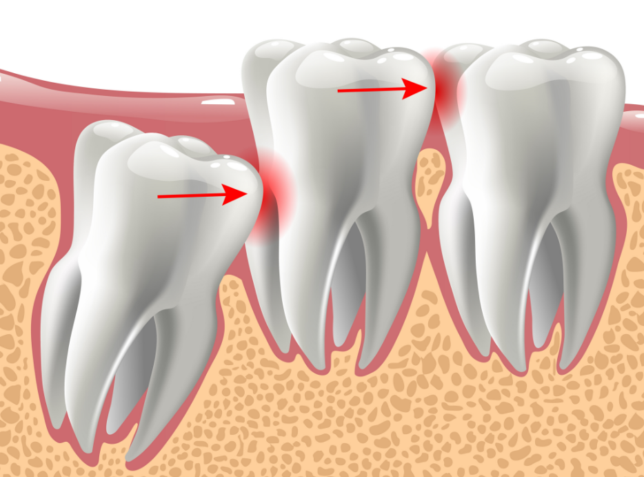 Illustration of wisdom teeth