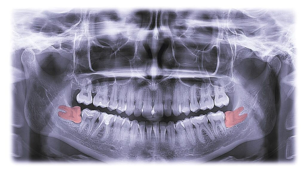 X-ray of mouth showing wisdom teeth sideways colored red